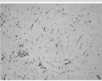 FIGURE 2 – Positive immunohistochemical expression of CD34 in neuroibromas  (LSAB 200×)