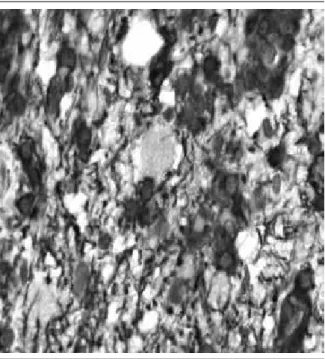FIGURE 8 –   Eosinophilic granular body negative for GFAP immunostaining  in  the center of the image (lens 40×)