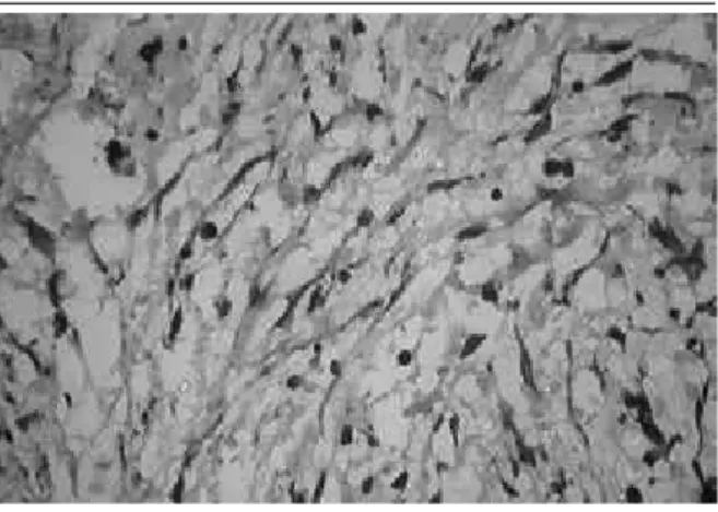 FIGURE 5 –  The neoplastic ibroblasts were positive for vimentin (VIMENTIN,  400×)