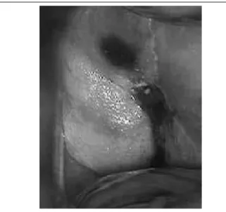 FIGURE 1 –  Colposcopy showing pigmented lesion on the anterior lip of the  uterine cervix (16×)