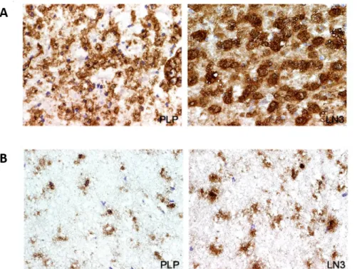Figure I. 2. Presence of microglia in active (A) or chronic (B) MS lesions. Frozen sections of autopsied brain samples  of MS patients were immunostained for PLP to detect white matter and for HLA-DR MHC class II clone LN3 to detect  macrophages/microglial