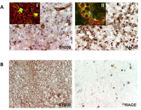 Figure I. 3. Expression of S100B and its receptor RAGE in active (A) and chronic (B) MS lesions