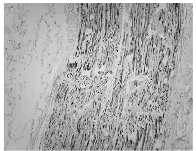FIGURE 3 –  Plexiform neurofibroma: positive immunoexpression for S100  antibody, streptavidin-biotin, 200×