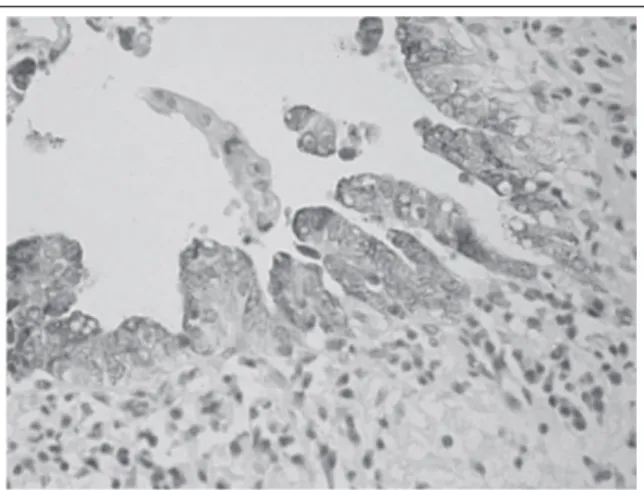 FIGURE 2 –  Expression of MUC5 in dysplastic epithelium of intrahepatic bile ducts