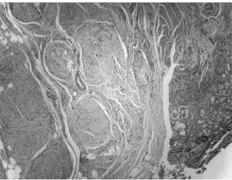 FIguRe 1 –  Plexiform neurofibroma: tortuous expansion of multiple nerve  fascicles caused by neurofibroma cells, affecting gastric wall, HE, 40×