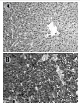 FIGURE 5 –  Pattern of cytoplasmic immunostaining for liver TNF-α  A) in the control group (25×); B) intense and diffuse cell staining associated to  steatosis in the group on the high-fat diet (25×).