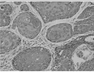 FIGURE 1 –  Morphological aspect of a case of oral squamous cell carcinoma  (Inca) used as a guide to select the tissue area of interest during manual  microdissection (H&amp;E; 200× magniication)
