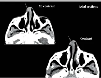 FIGURE 1 –  Post contrast CT image reveals an enhanced lesion in nasal dorsum CT: computed tomography.