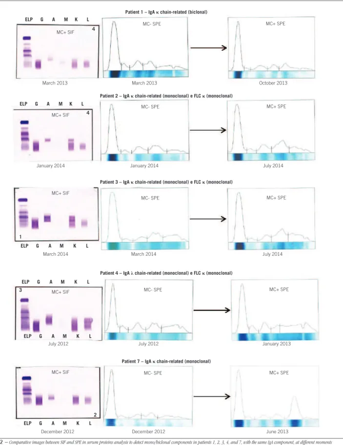 FIGURE 2  −  Comparative images between SIF and SPE in serum proteins analysis to detect mono/biclonal components in patients 1, 2, 3, 4, and 7, with the same IgA component, at different moments MC+ and MC- indicate the presence and absence of mono/biclona