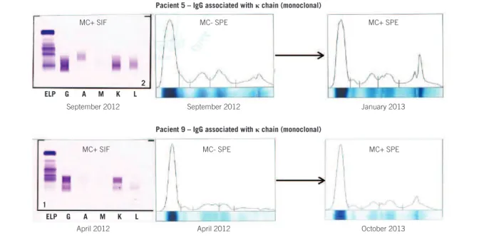 FIGURE 3 − Comparative images between SIF and SPE in serum proteins analysis to detect MC in patients 5 and 9, with the same IgG component, at different moments