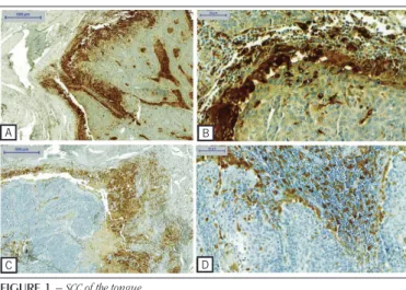 TABLE 5  − Comparison of immunostaining for CD163 and CD68 in the groups with absent and present metastasis