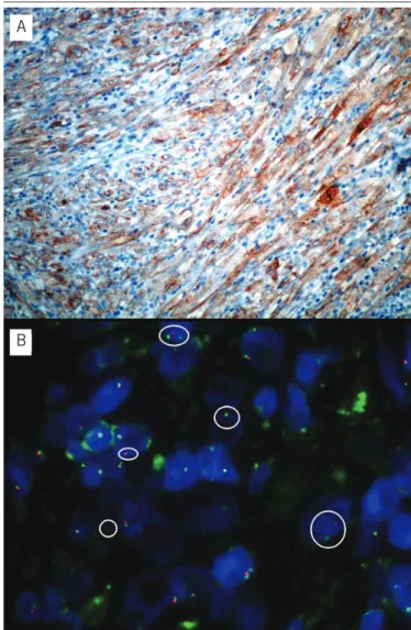 figuRE 3  − Immunohistochemistry and FISH for ALK 