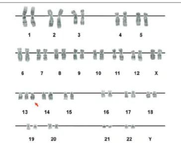FIGURE 2 − Skin karyotype of the patient. The arrow indicates the additional chromosome  13, a finding compatible with full trisomy 13 or Patau syndrome 