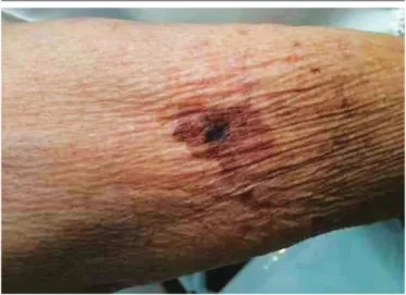 FIGURE 1  − Hyperpigmented brownish plaque, asymmetrical, irregular border, more  than one color, approximately 2.5 cm in diameter in the right upper limb