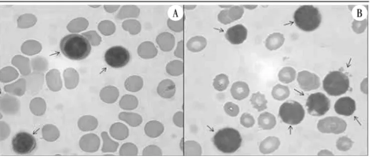 FIGURE 1 − Morphology of B lymphoid precursors (arrows) in BM aspirate samples  stained by May-Grünwald-Giemsa