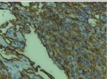 FIGURE 4  −  Blood vessels of varying sizes lined by endothelial cells with an epithelioid  pattern (HE, 400×)
