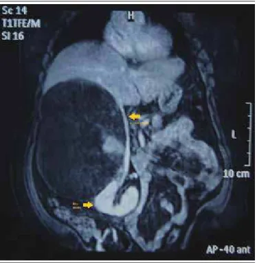 FIGURE 5  −   Neoplasm formed by adipocytes and elements of the three hematopoietic  lineages (erythroid, myeloid and megakaryocytic)
