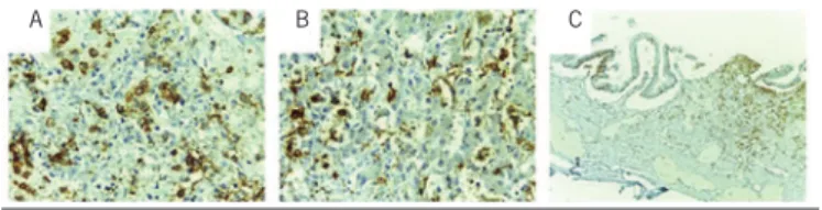 FIGURE 6  − positive labeling for CD1a  A) lung; B) liver; C) gallbladder.