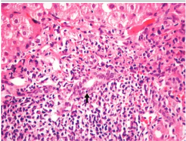 FIGURE 1  − Native liver with chronic hepatitis C: ductal degeneration – cytoplasmic  eosinophilia and loss of nuclear polarization (1,000×)