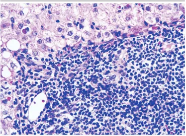 FIGURE 3  − Native liver with chronic hepatitis C: perivenulitis with centrilobular vein  endotheliitis (400×)