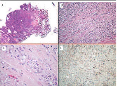 FIGURE  − Morphological and immunohistochemical characteristics of the resected  specimens