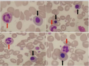 FIGURE 1 − BMN pathophysiology: inflammation and plugs of sickle cells or neoplastic  cells cause vascular obstruction and disrupt oxygen/nutrient delivery to hematopoietic  tissue