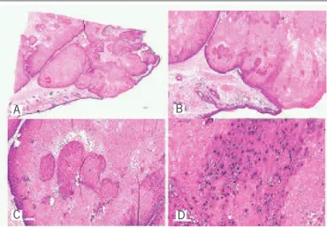 FIGURE 4  − Microscopic aspects of proliferating trichilemmal tumor