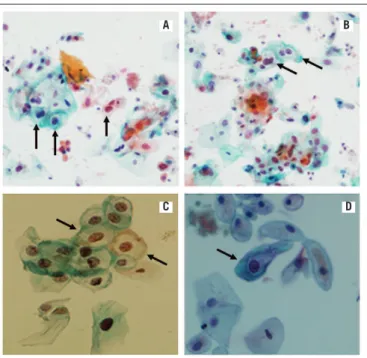 TABLE 1  − Patients’ profiles as to pre-transplant STDs and immune status at  the first post-transplant visit