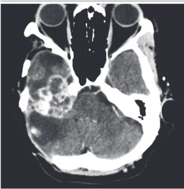 FIGURE 1  − Aggressive papillary tumor of endolymphatic sac: CT showing an expansile  lytic lesion arising in the right temporal bone (A and B)
