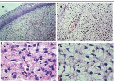 FIGURE 3  − Strongly positive immunostaining for progesterone receptor (100×)FIGURE 1  − AAM in HE staining revealing a fragment of squamous mucosa with spindle-cell neoplastic proliferation in loose collagenous stroma with a myxoid matrix embedding irregu