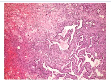 FIGURE 3  − Well-differentiated area of angiosarcoma with vessels lined with atypical  endothelium permeating myocardiocytes (HE, 40×)
