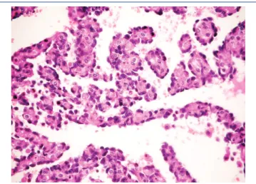 FIGURE 6  − Detail of the formation of papillae lined with atypical endothelium (HE, 400×) HE: hematoxylin and eosin.
