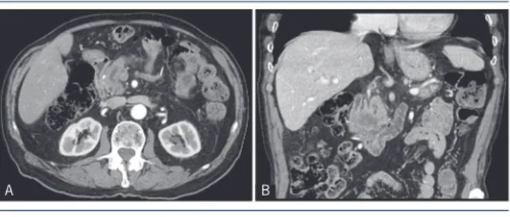 FIGURE 1  − CT scan