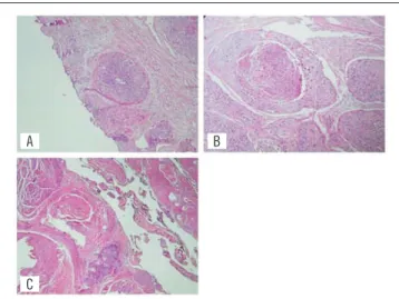 FIGURE 3  − Histopathology showing keratinizing squamous cell carcinoma mildly- mildly-differentiated