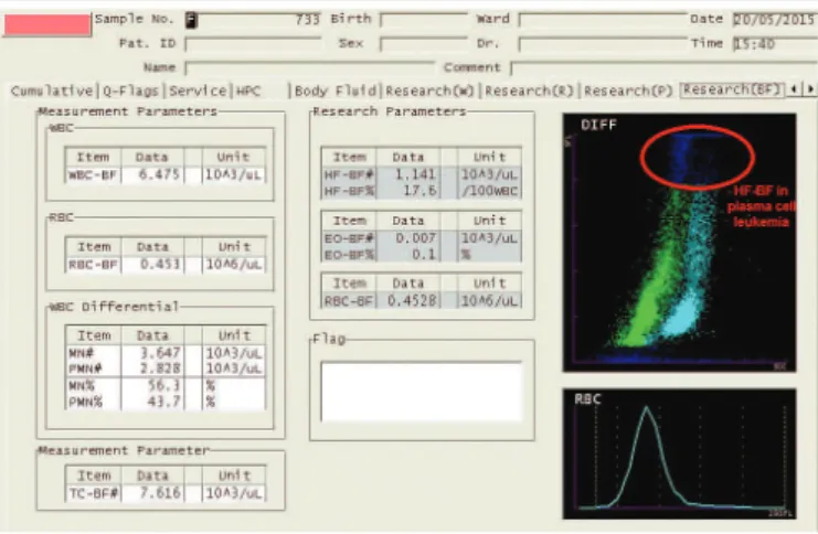 FIGURE 2  − Scattergram displayed on XE-5000 from a pleural effusion with plasma cells  in plasma cell leukemia 