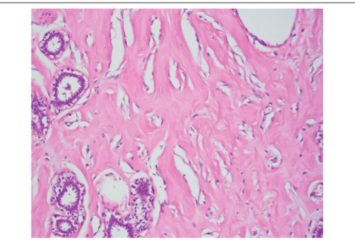 FIGURE 2  − Slit-like spaces in left-breast tumor are lined by a discontinuous layer of  bland spindle cells that lack nuclear atypia and mitosis (HE 400 × )