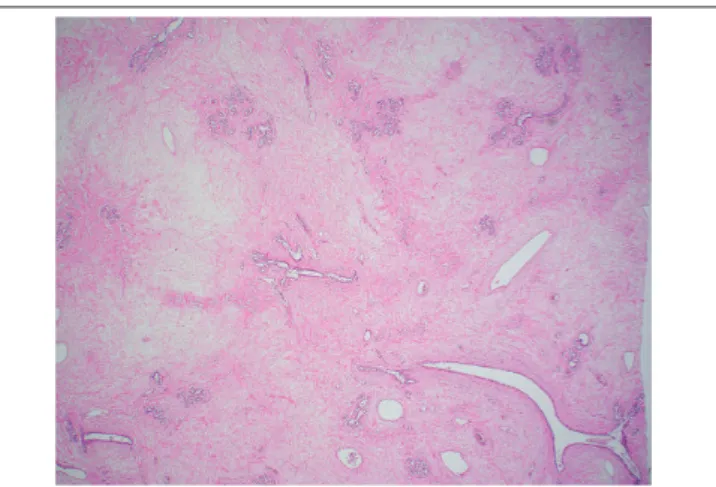 FIGURE 4  − Areas of abundant edematous stroma in the left-breast tumor (HE 40 × ) HE: hematoxylin and eosin.