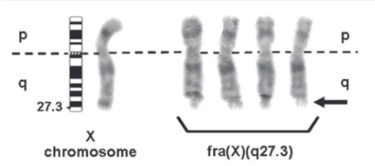 FIGURE  − Partial GTG-Banding karyotypes (≥ 550 bands) showing a normal X and  fragile X [fra(X)(q27.3)] chromosomes