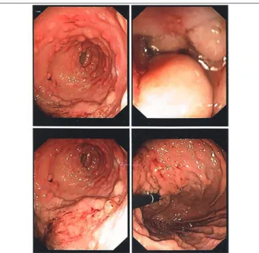 FIGURE 5  − Control gastrointestinal endoscopy evidencing hypertrophy of gastric mucosa  folds, diffuse polypoid lesions and elevated lesion in body-antrum transitional zone