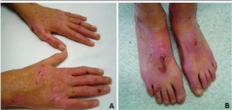 FIGURE 1 − Images of the patient’s hands and feet showing blistering and scarring skin  lesions, in addition to dystrophic and missing nails (especially in the feet), secondary to EB EB: epidermolysis bullosa.