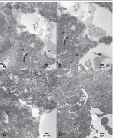FIGURE 2  − Images obtained through TEM, in scales of 200 nm (A-C) and 2 µm (D),  showing cleavage at the level of sublamina densa, which is consistent with the diagnosis of  DEB