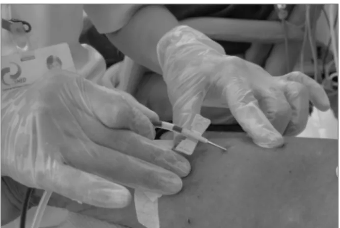 Figure 1. “Touch cannulation” technique – the profes- “Touch cannulation” technique – the profes- profes-sional performing the puncture holds the needle by the  flexible tube and not by the plastic “butterfly”