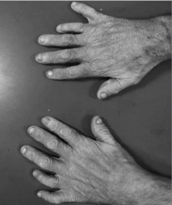 Figure 1. Polydactyly of case 1.