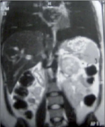 Figure 1. Computed tomography scan of the abdomen with contrast  uptake showing a large heterogeneous tumor in the left adrenal  territory.