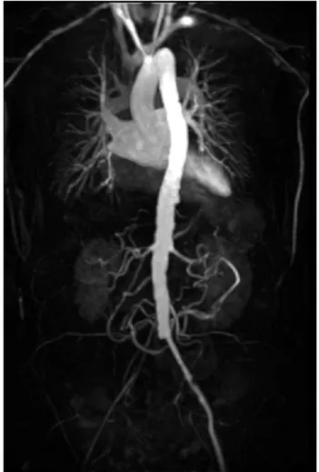 Figure 1. Coronal MRA showed an occlusion of the left subclavian  artery, of the right common iliac artery and also of the superior  mesenteric artery with moderate stenosis in the middle third of the  right renal artery.