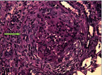 Figure 1. Crescente fibrocelular (seta verde) com compressão do tufo  glomerular residual (PAS, x 400).