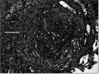 Figure 1. Fibrocellular crescent (green arrow) with compression of 
