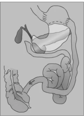 Figure 4. Biliopancreatic diversion with duodenal switch.