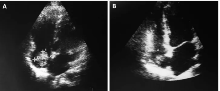 Figure 1. A. Transthoracic echocardiogram (TTE) showing right atrial mass measuring 28 x 16 mm consistent with thrombus