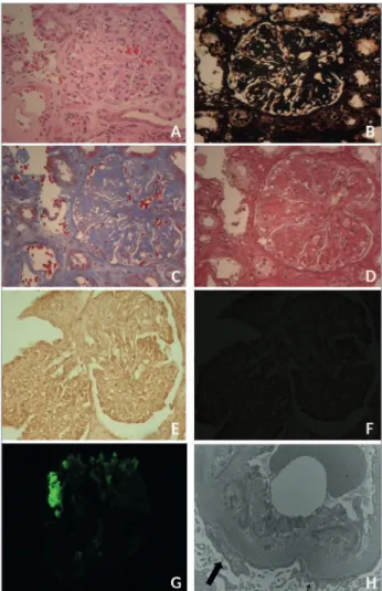 Figure 1. Histology changes in Idiopathic Nodular Glomerulosclerosis. 